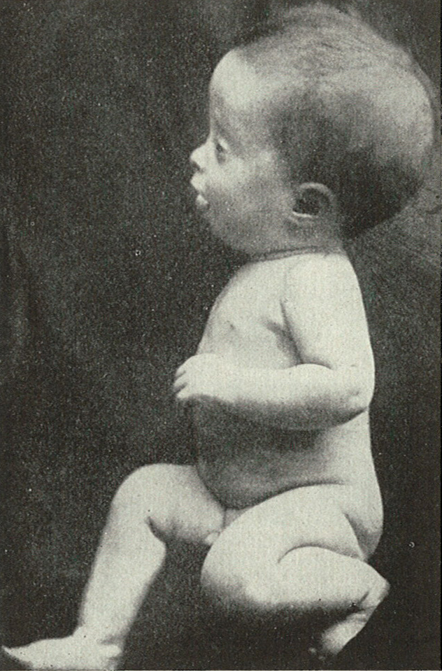 Baby suffering from hydro-cephalus.