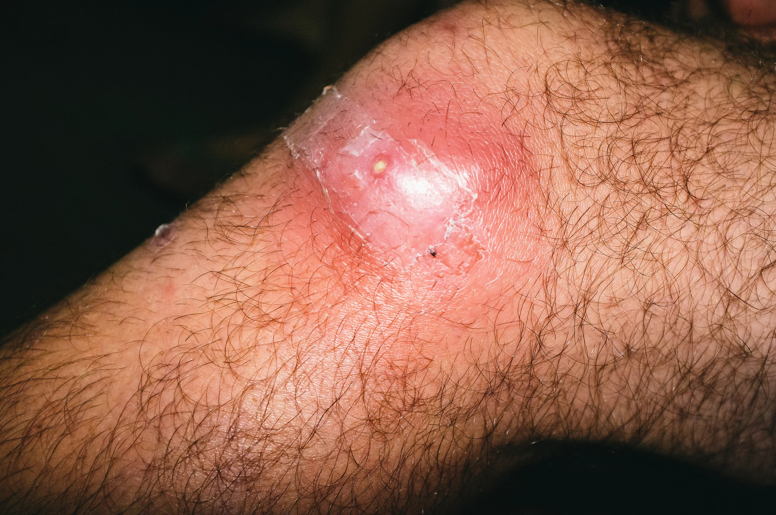 Dive Instructor's Mysterious Bite.jpg