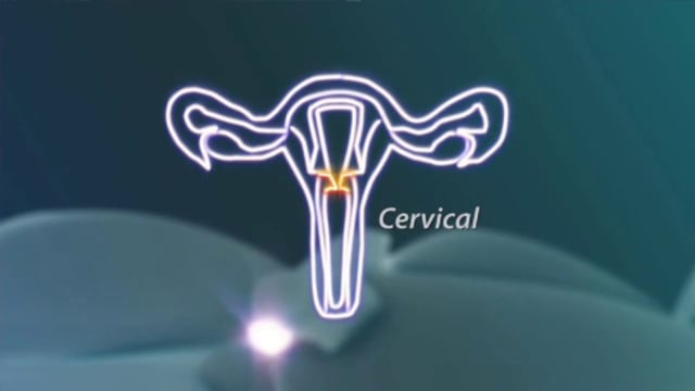 Lo Que Cada Mujer Debe Saber: Cáncer Cervical