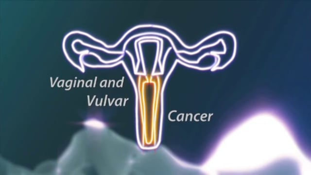 Lo Que Cada Mujer Debe Saber: Cáncer Vaginal y Vulvar