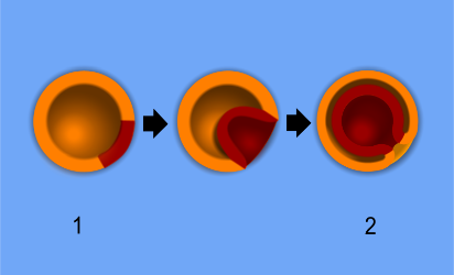 Figure 7. Gastrulation of a diploblast. The formation of germ layers from a (1) blastula to a (2) gastrula. Certain ectoderm cells (orange) move inward forming the endoderm (red). The pore created during gastrulation, known as the blastopore , becomes the opening responsible for ingestion and excretion.