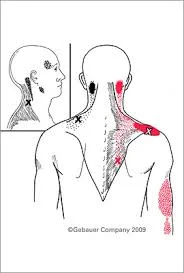 Do you also have pain in these areas?