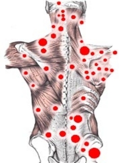 fibromyalgia-trigger-points.jpg