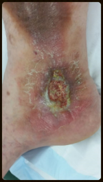   Ulcer in a 38 year old Ipswich man with varicose veins  