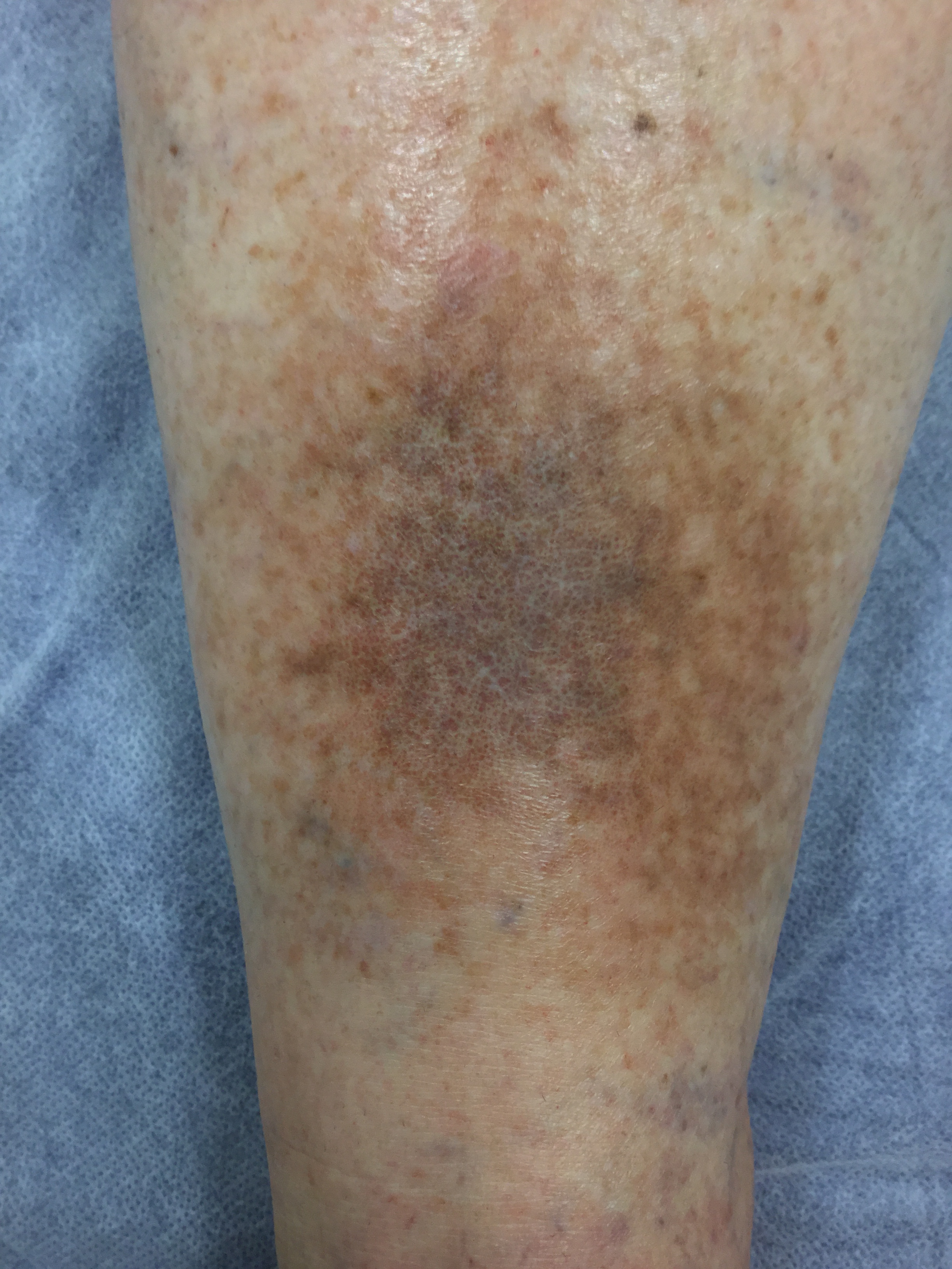  Lipodermatosclerosis due to untreated Varicose Veins. 
