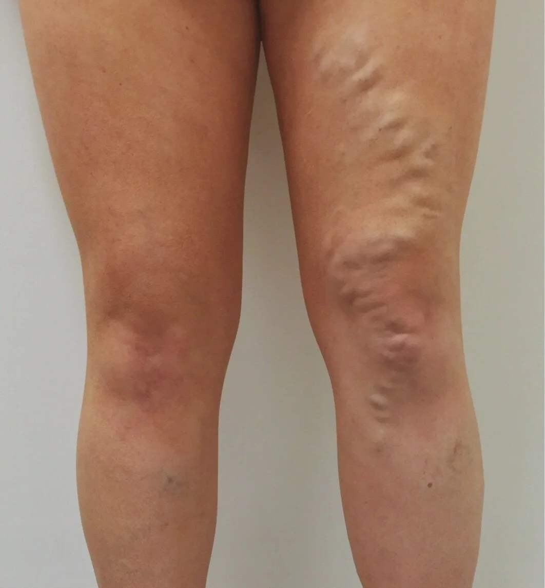 28 year old female with GSV incompetence treated with EVLT . 