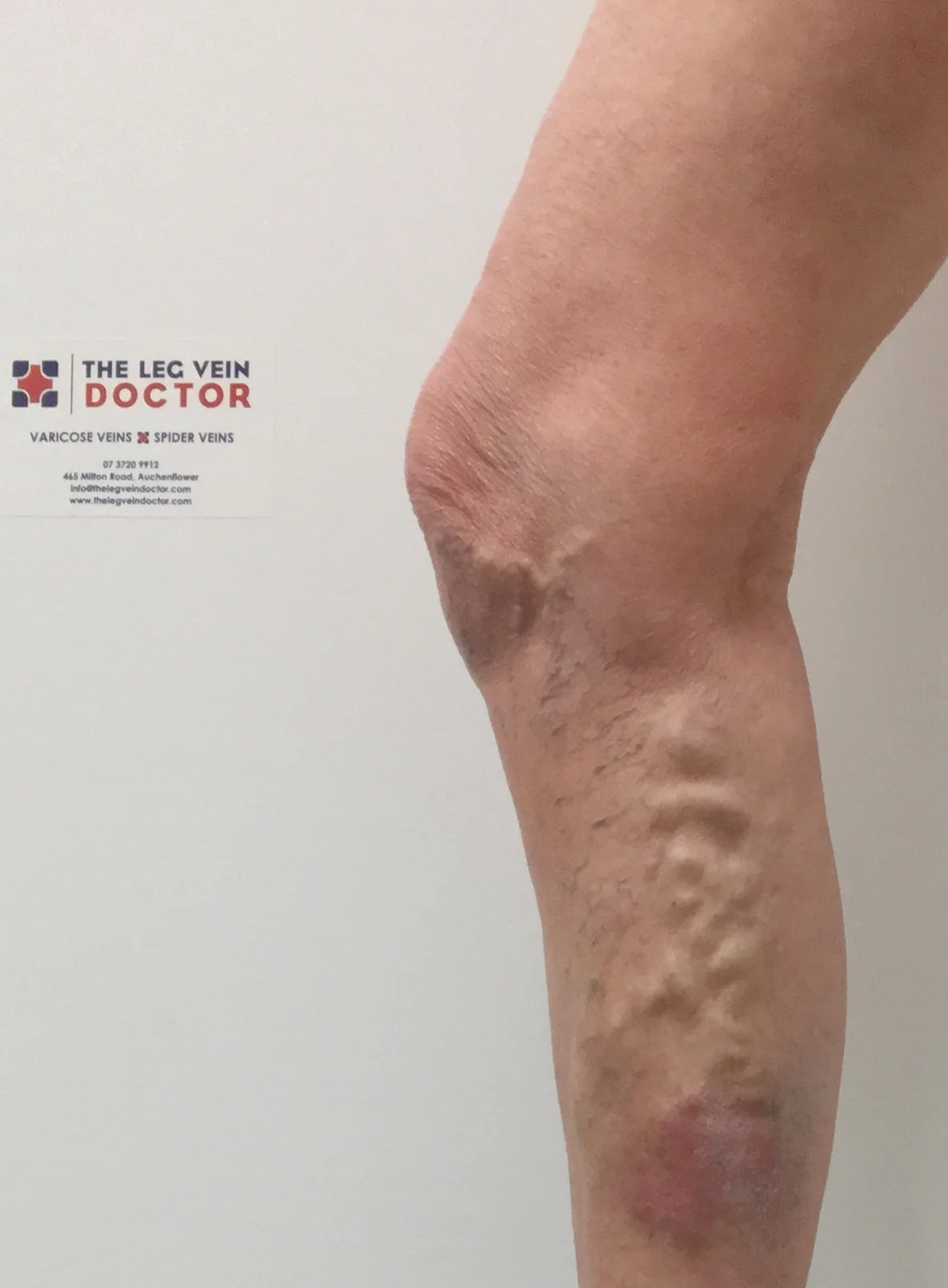 Varicose vein removal glue laser ultrasound the leg vein doctor