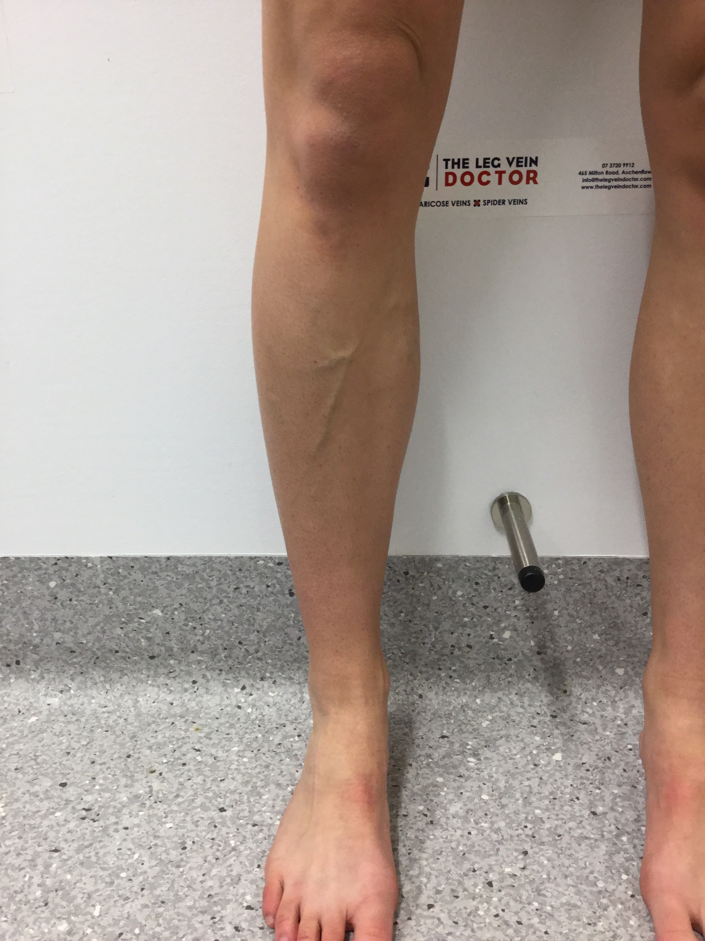 Varicose Vein Results And Post Treatment Photos — The Leg Vein Doctor