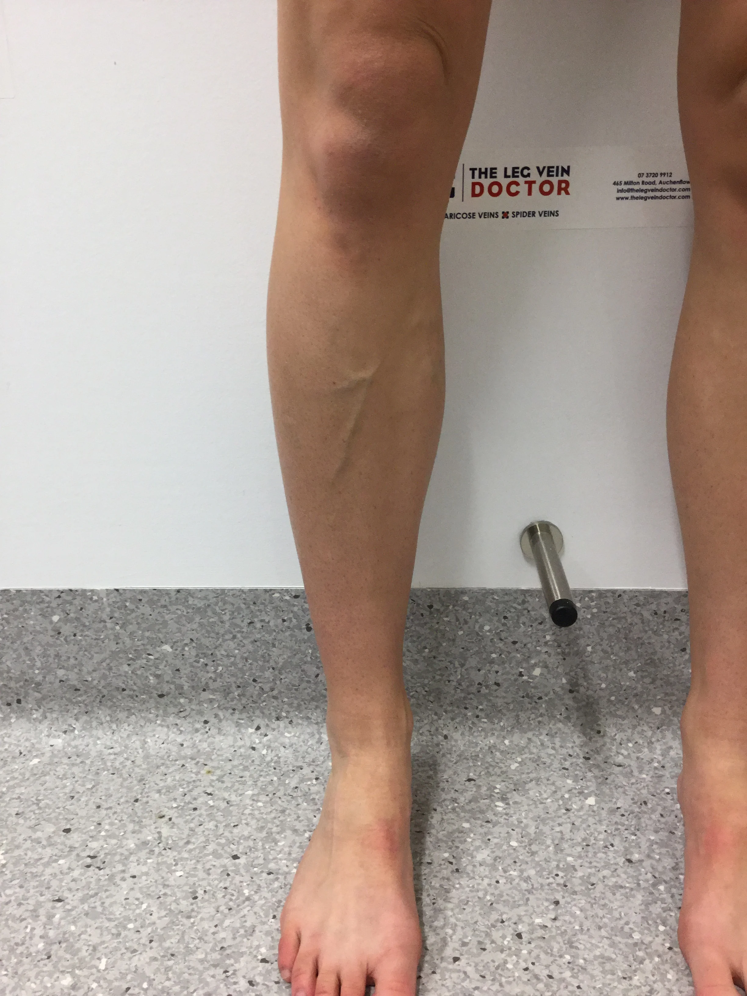 Varicose Vein Results and post treatment photos. — The Leg Vein Doctor