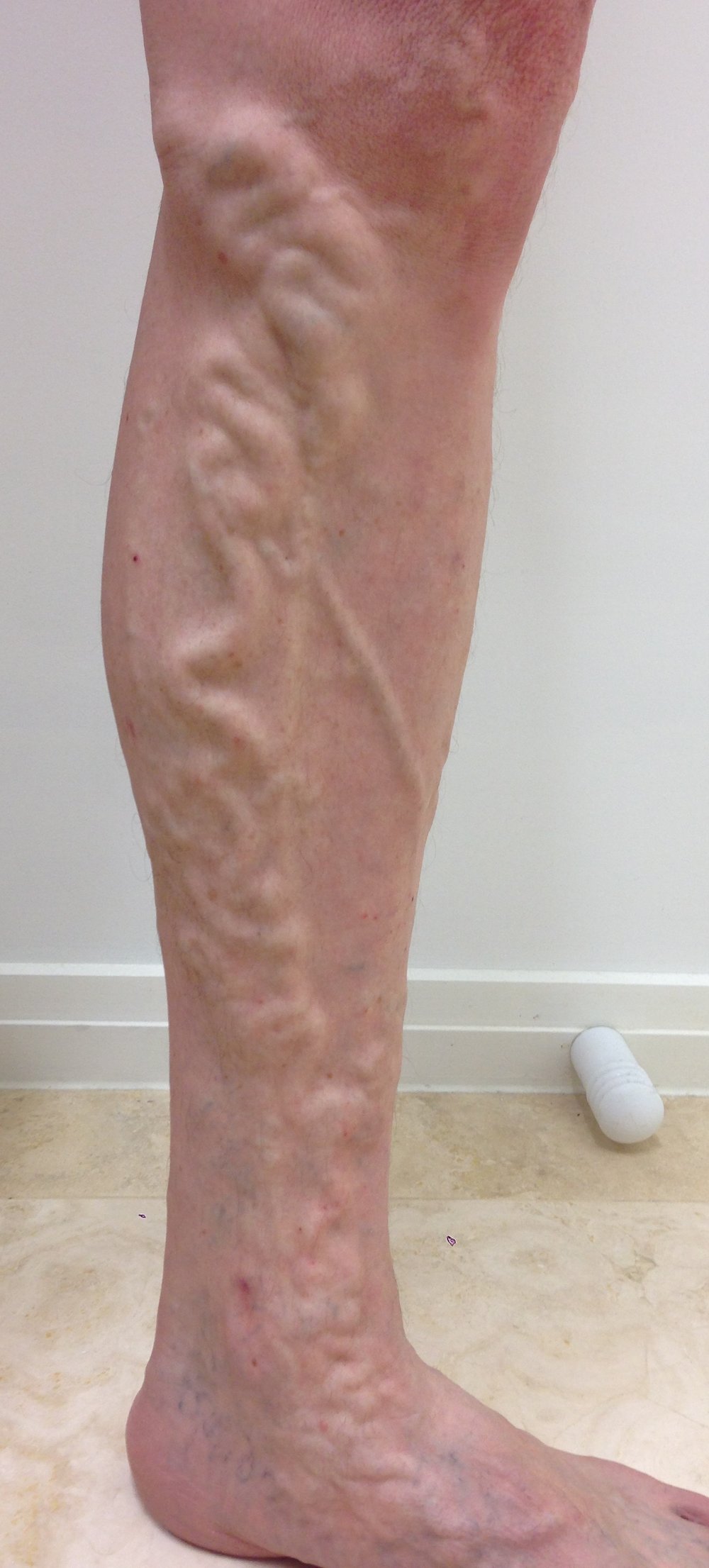 Tratarea venelor varicoase la nivelul picioarelor - Venoten