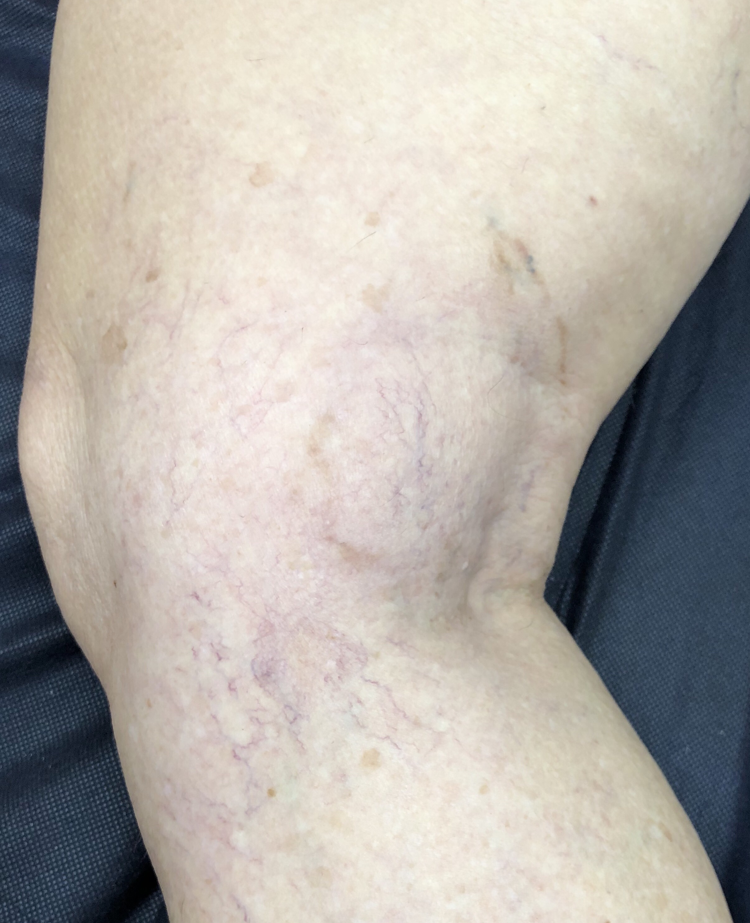  After. At 3 months. Sclerotherapy 2 treatments. 