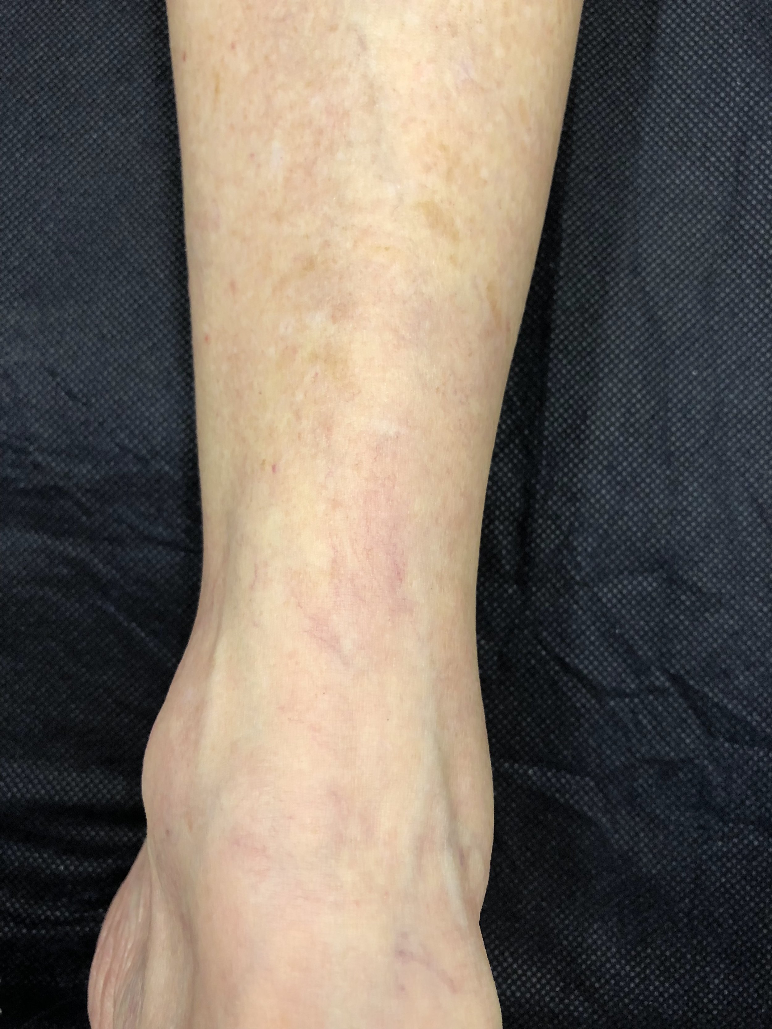  After - 3 months. Sclerotherapy 2 treatments 