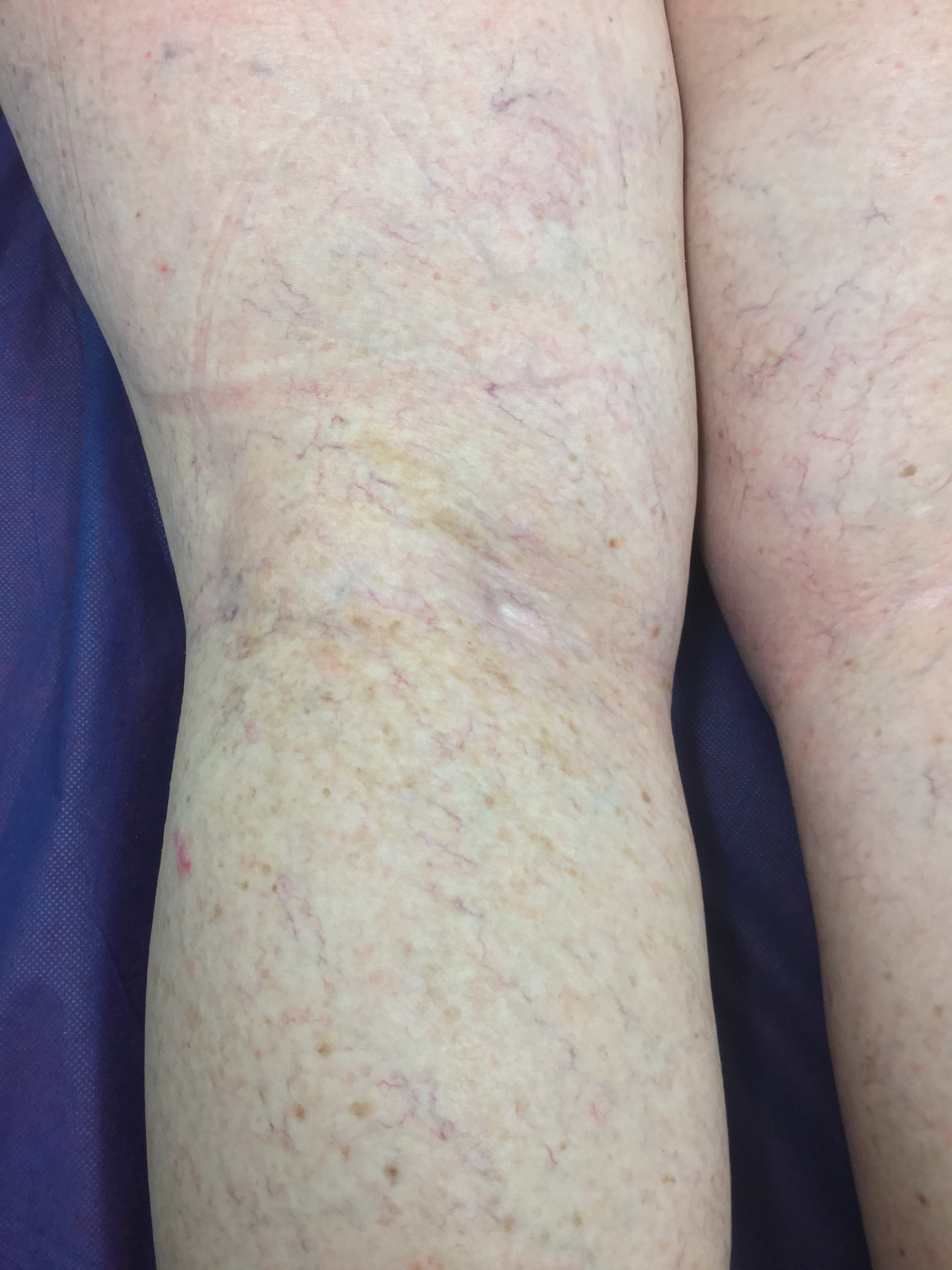    After. 6 Months Sclerotherapy 4 sessions. 