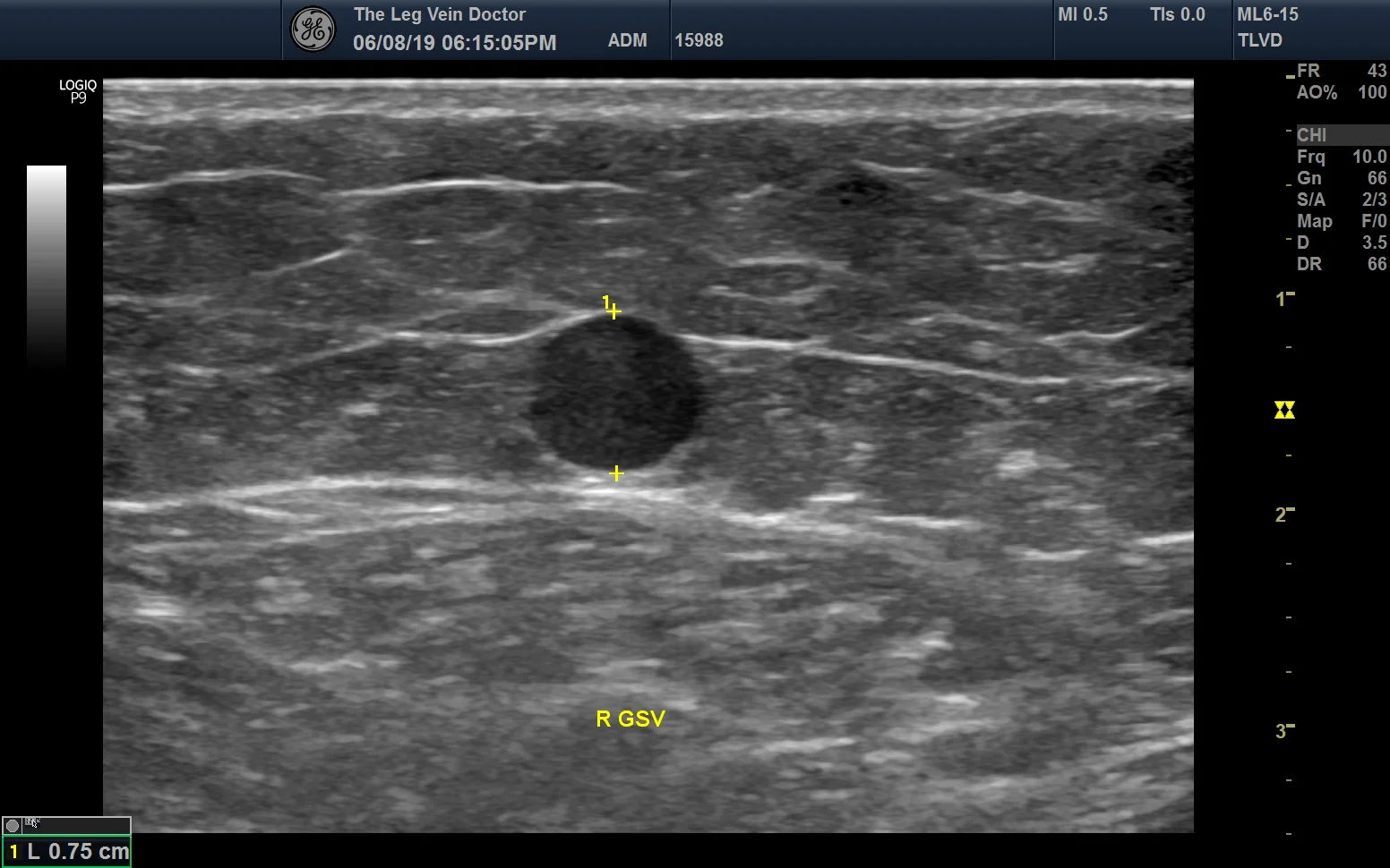 Incompetent right Great Saphenous vein seen in cross section showing gross enlargement (7.5mm) in a 36 year old man with severe varicose veins in the lower leg.