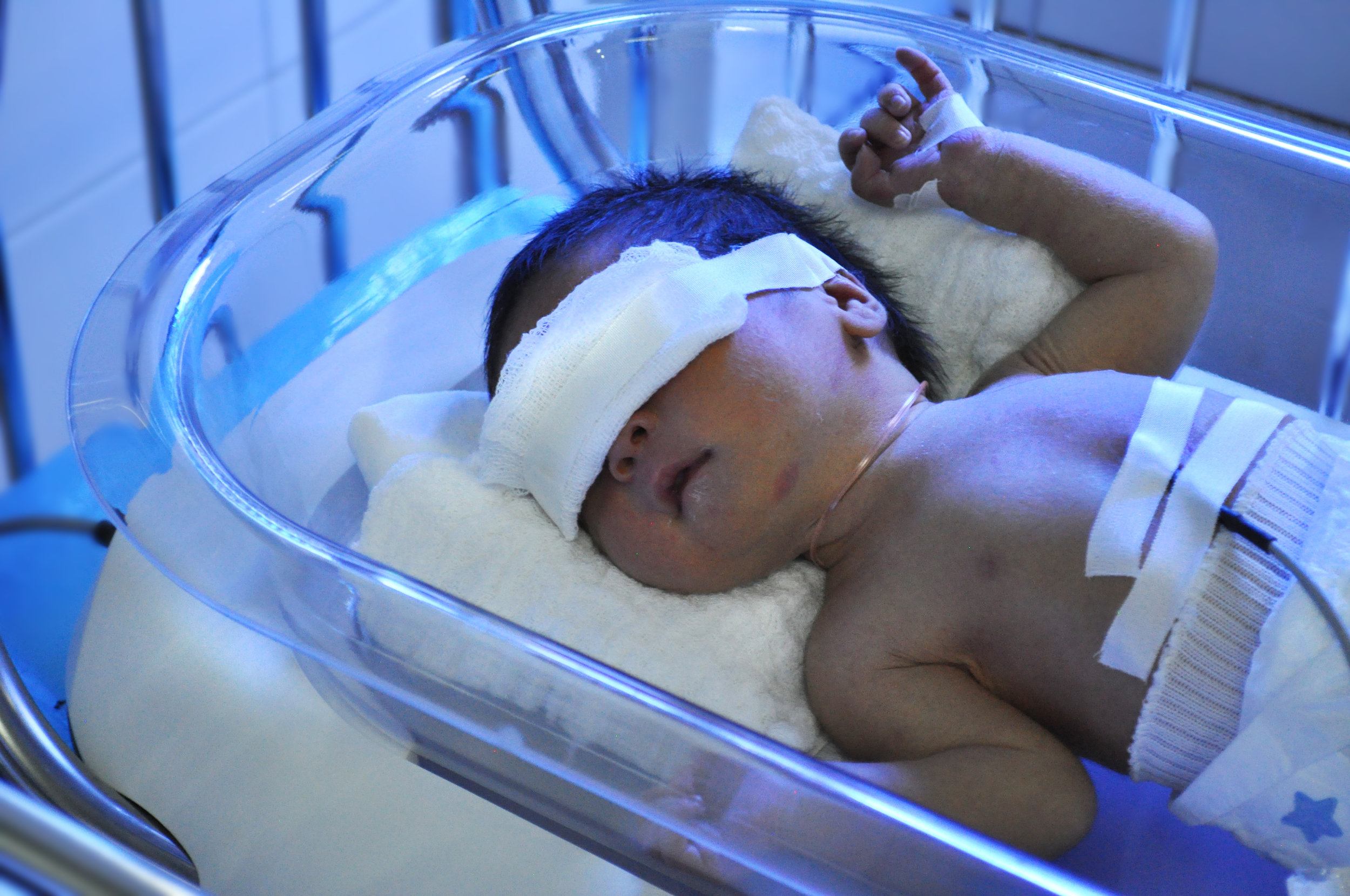 Недоношенный кровоизлияние. Выхаживание недоношенных. Недоношенный новорожденный. Повязка для фототерапии новорожденных. Фототерапия недоношенных.