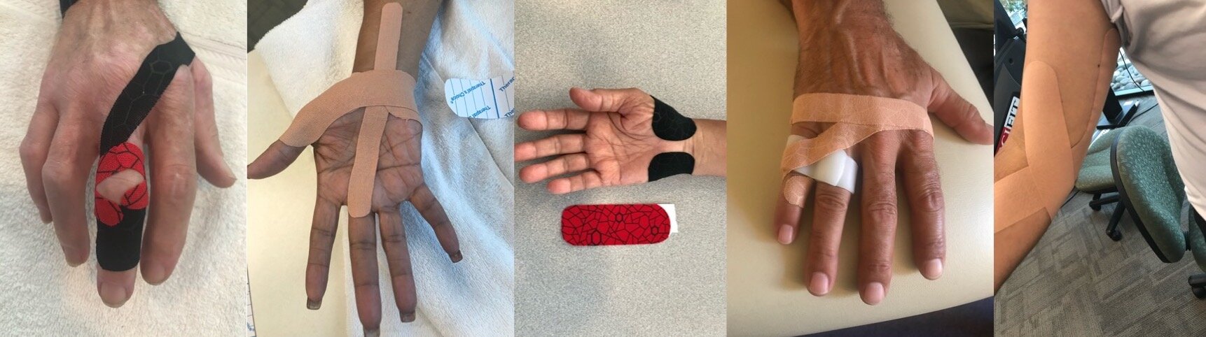 Little fingers, little problems! – Fife Virtual Hand Clinic