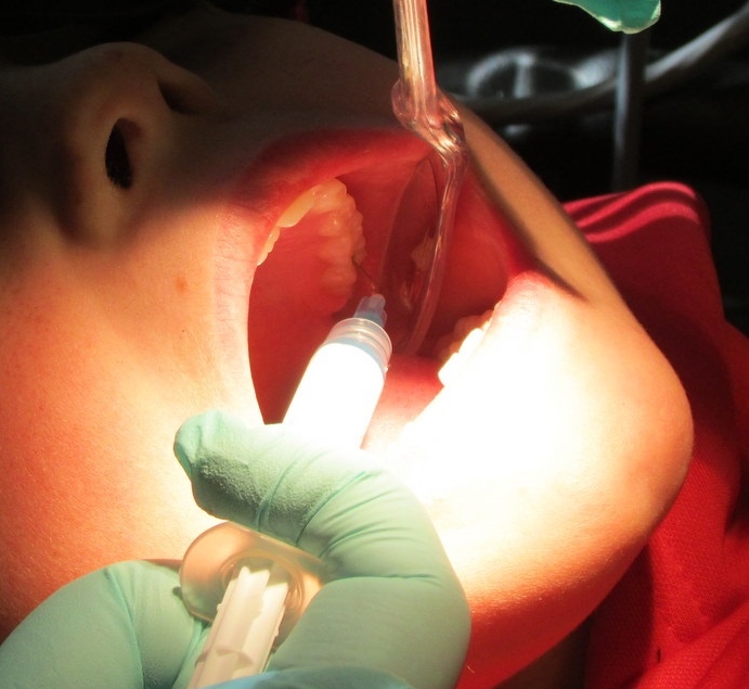   Sealants   Applying etch gel to rough up the surface of the tooth to create a better bond for the sealant material. 