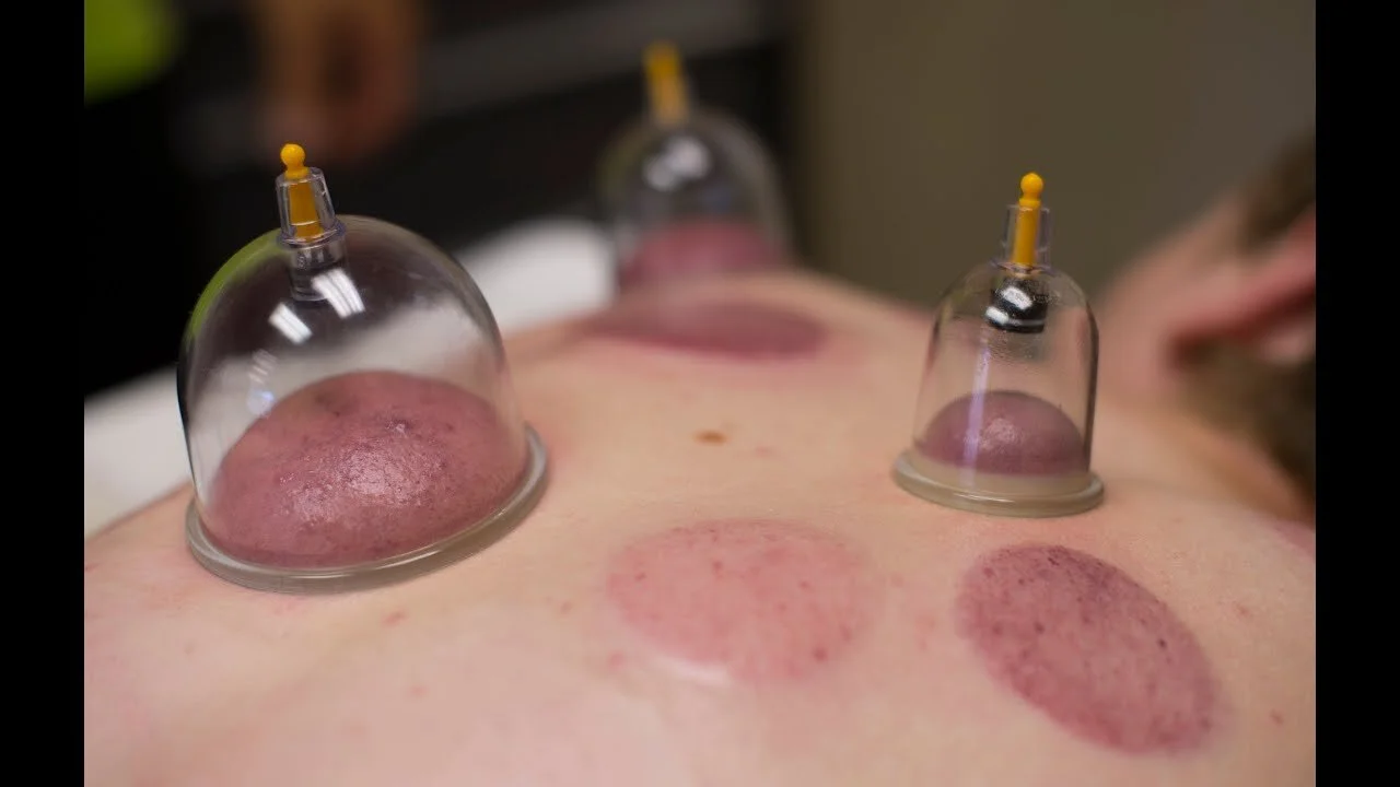cupping.jpg
