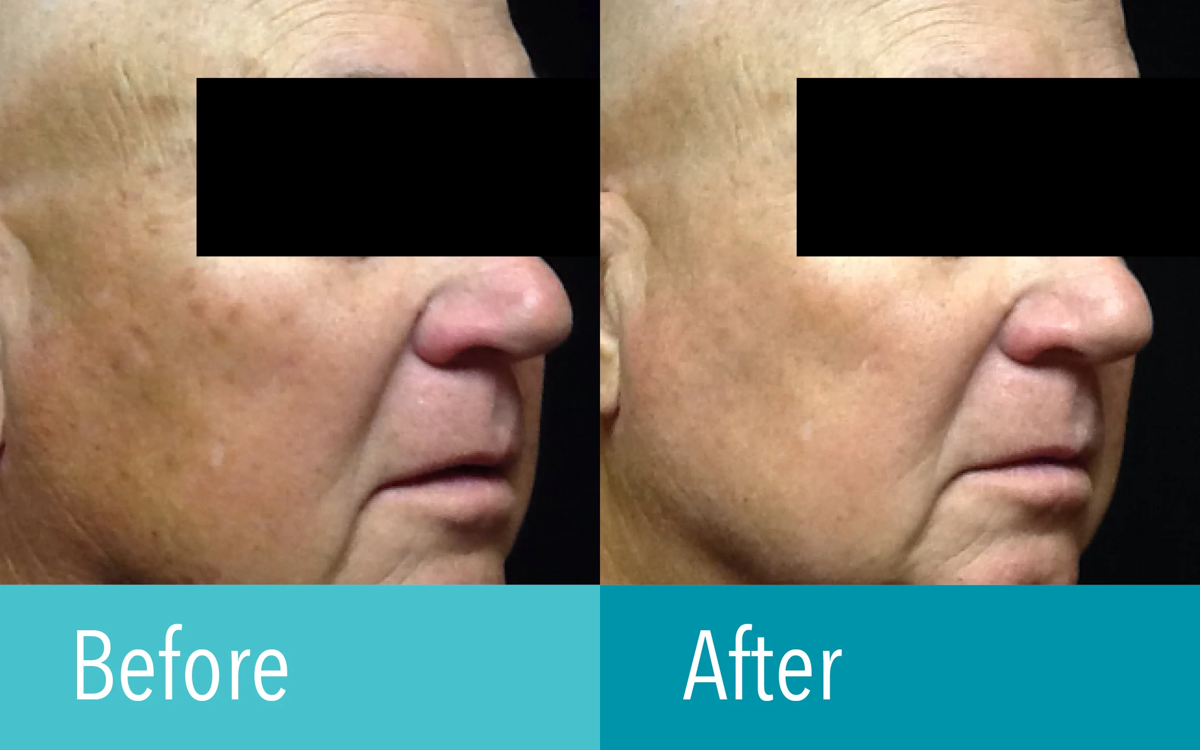 Photo courtesy of The Laser Cosmetic Center at Dermatology Associates