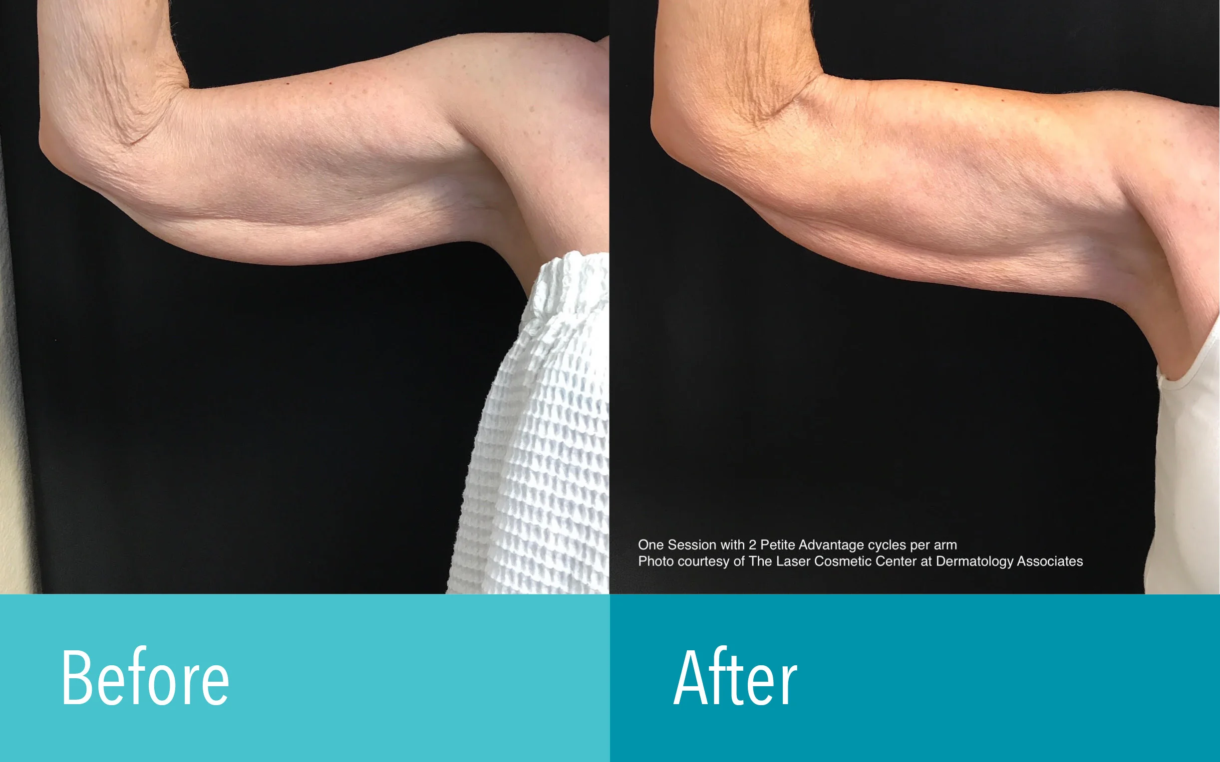 Photo courtesy of The Laser Cosmetic Center at Dermatology Associates