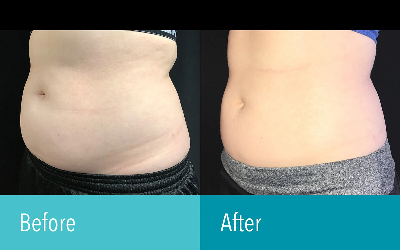 Photo courtesy of The Laser Cosmetic Center at Dermatology Associates
