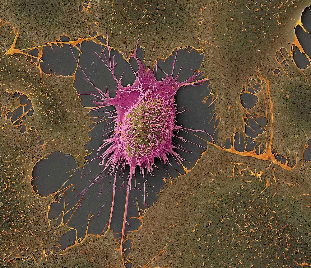 Cancer Cell Under Electron Microscope