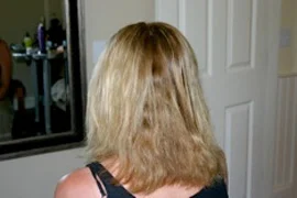 This lady had rows and rows of this damage and bald patches all over her head.