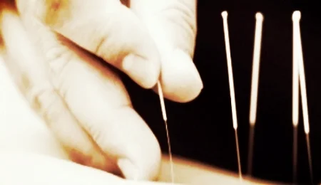 bigstock_acupuncture_12557702A-300x225.jpg