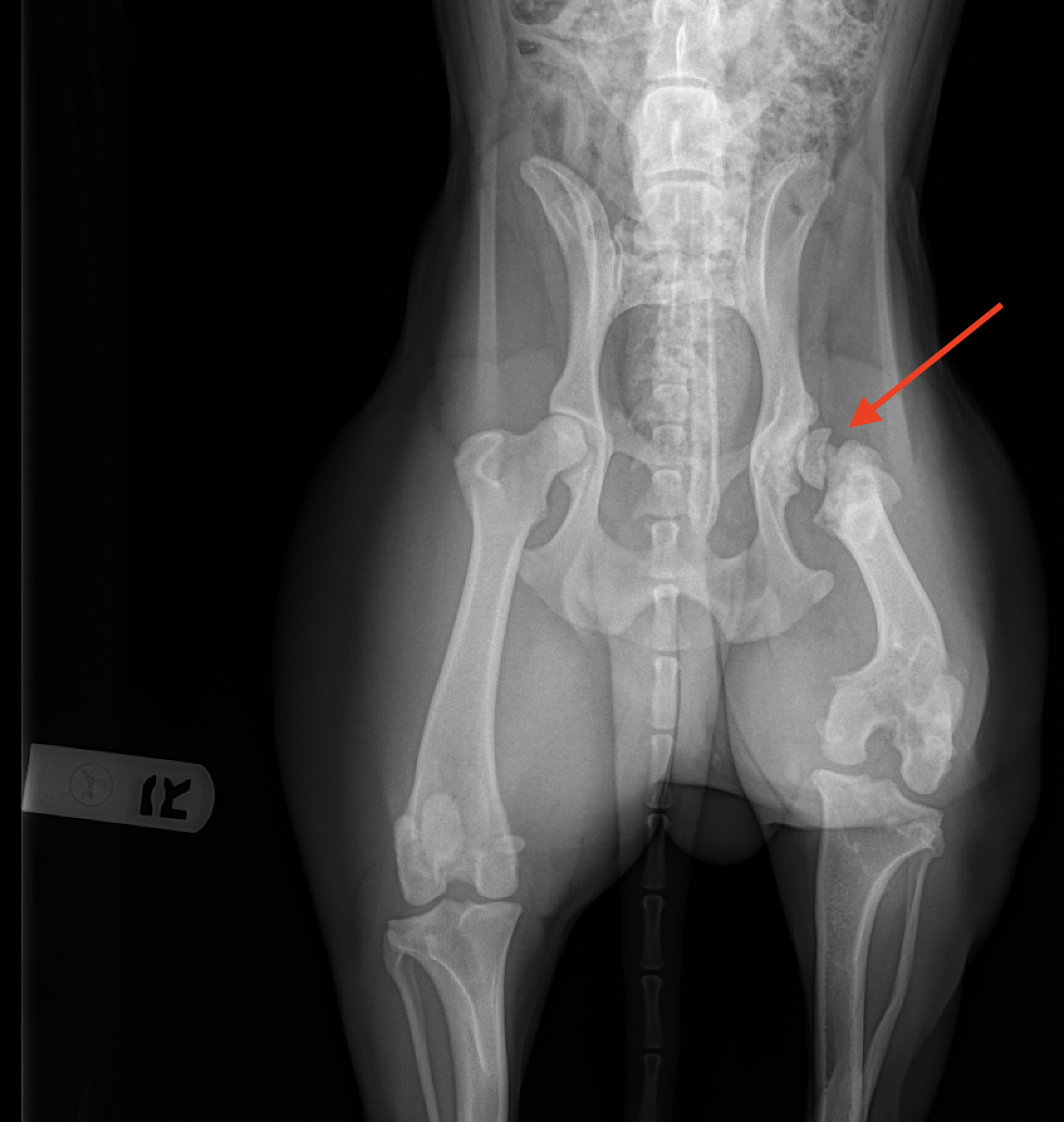 Broken hip socket