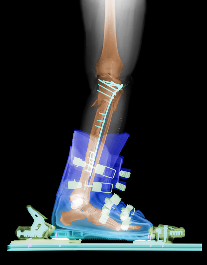 Fractured Tibia In Ski Boot