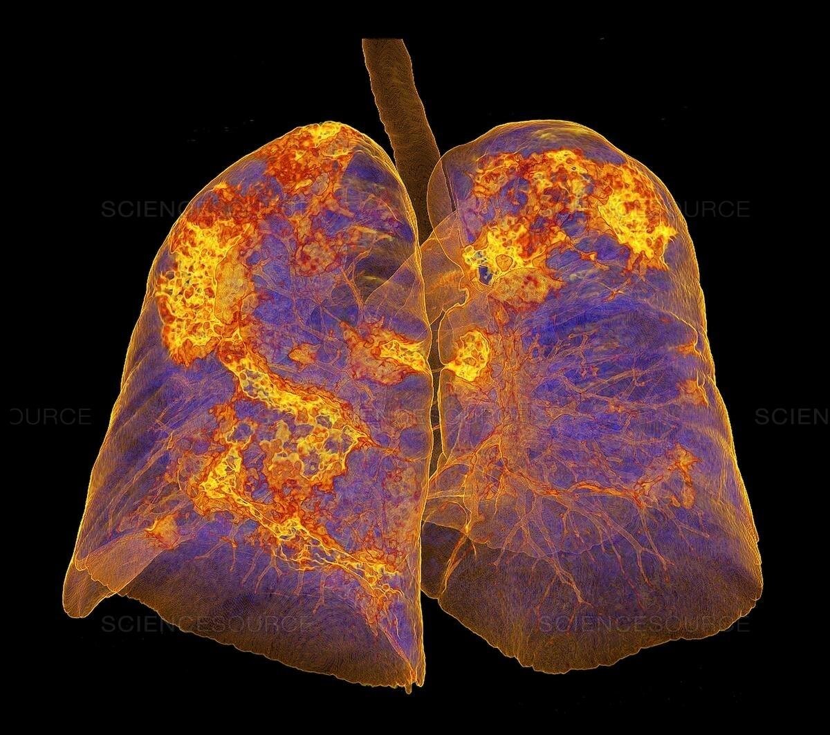 Lungs Affected by COVID-19 Atypical Pneumonia, 3D CT Scan