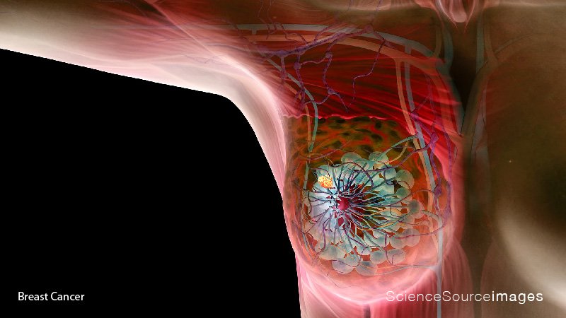 3D Illustration of Breast Cancer