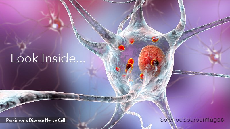 Parkinson' Disease 3D illustration