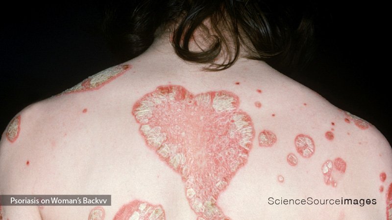 Psoriasis on a Woman's Back