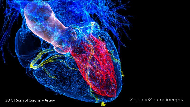 3D CT Scan of the Heart