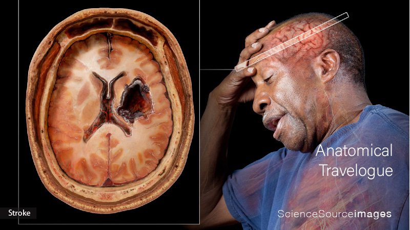 Stroke and Blood Flow