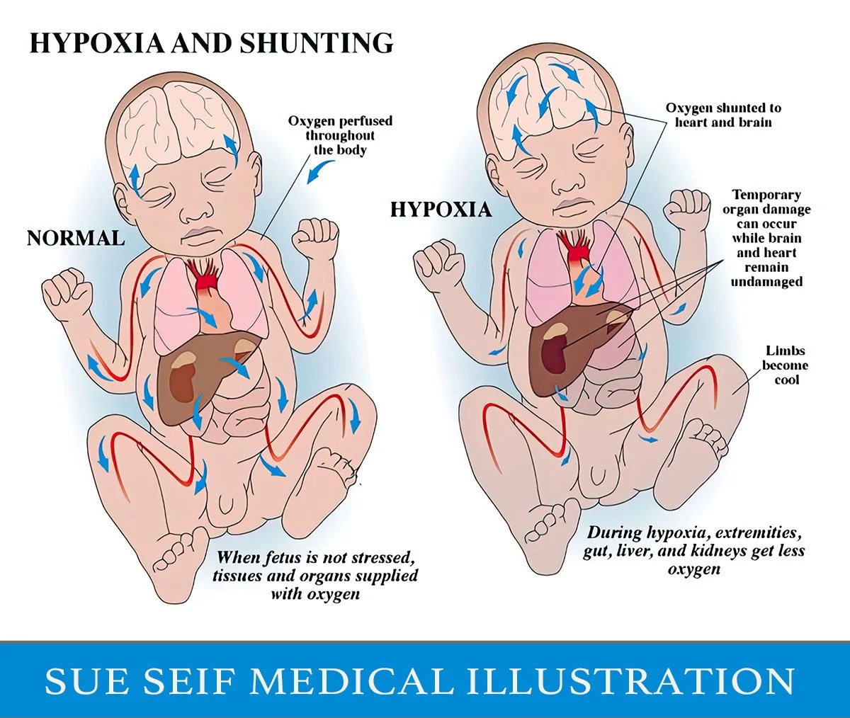 Medical illustration of an infant in hypoxia and shunting.
