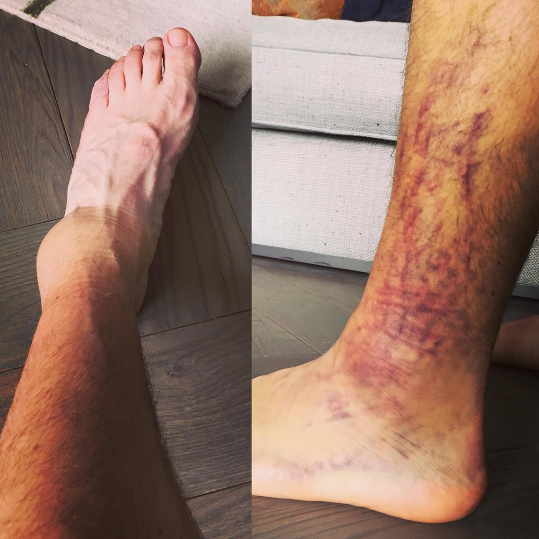 Rory McIlroy's ankle. Click to expand. Image: Instagram/Rory Mcilroy