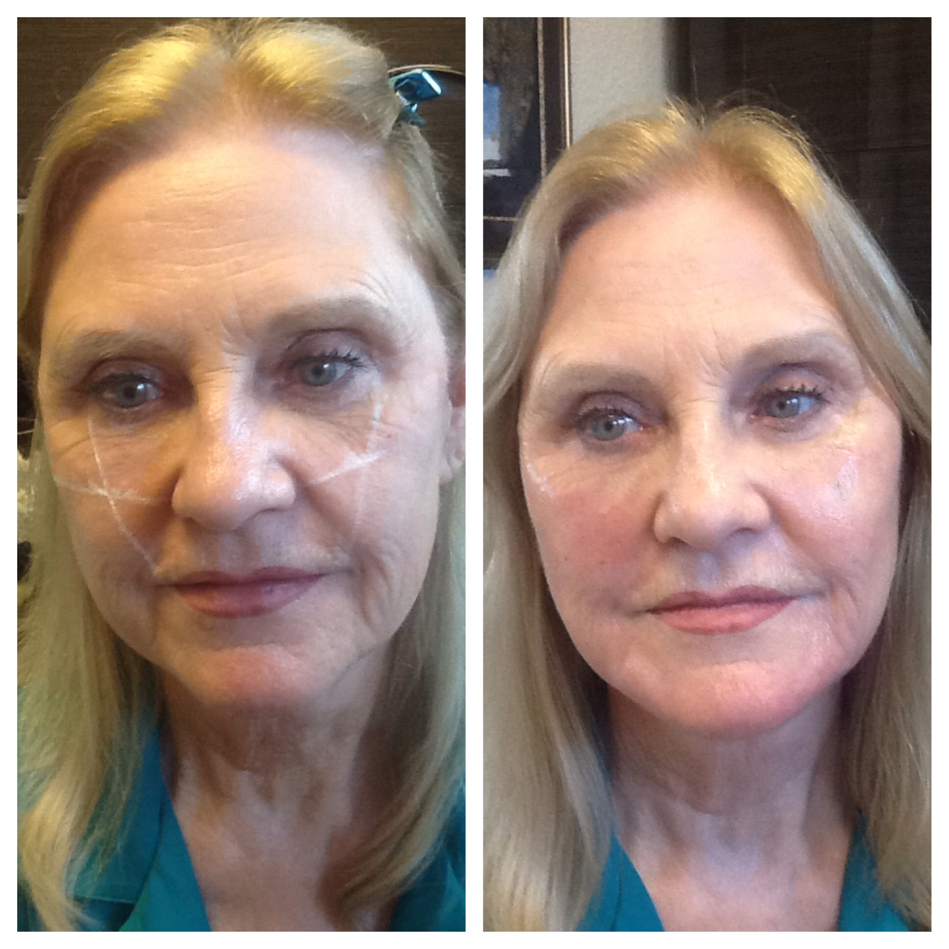 Dermal filler full face