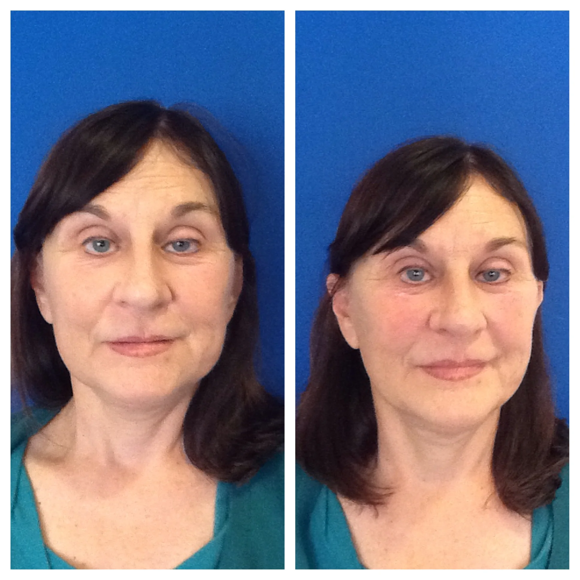Dermal filler for lateral mid face lift