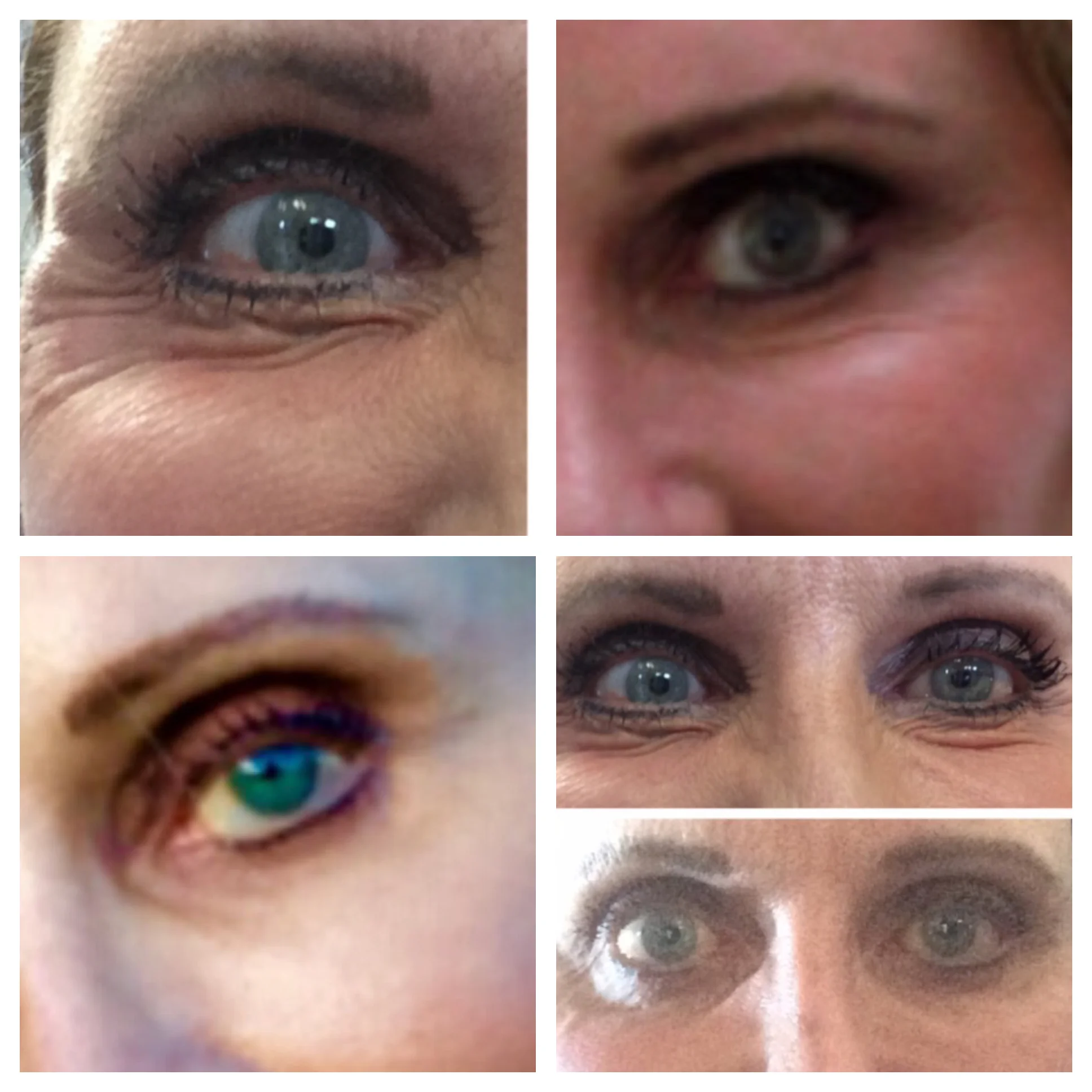 Botox for "crows" and under eye wrinkles
