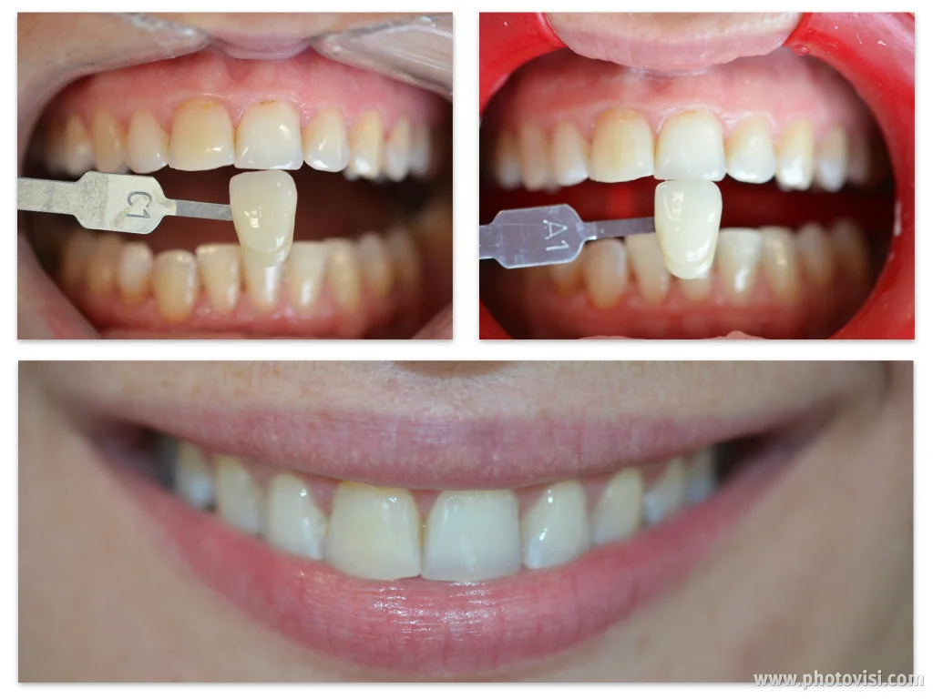 Links voor, rechts & onder: na