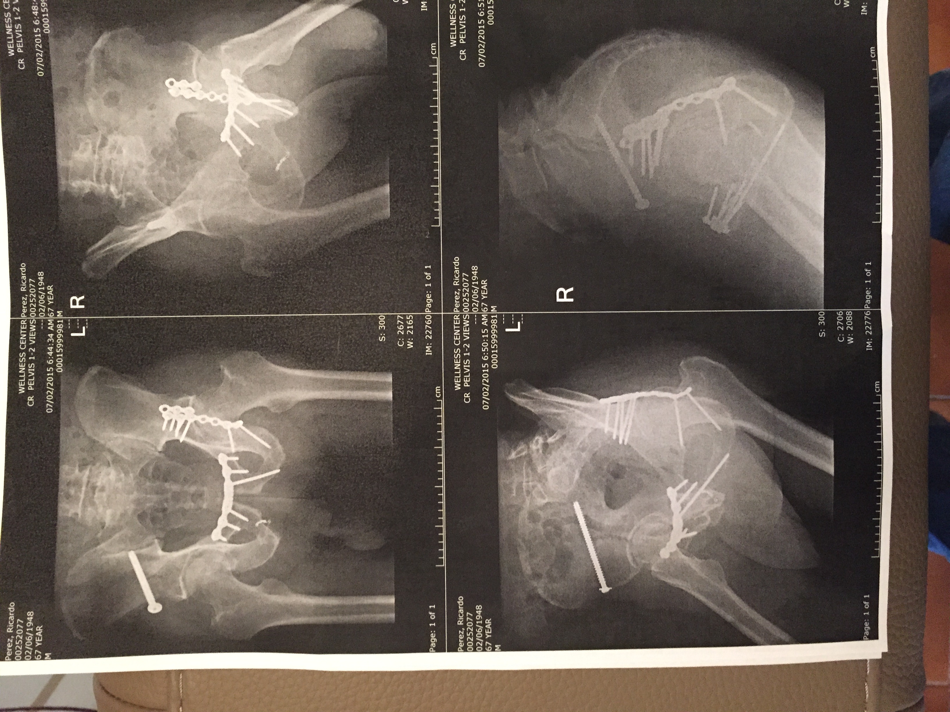 Here's the pelvic area. Not a pretty site. I broke it in four of five places and had three surgeries. 