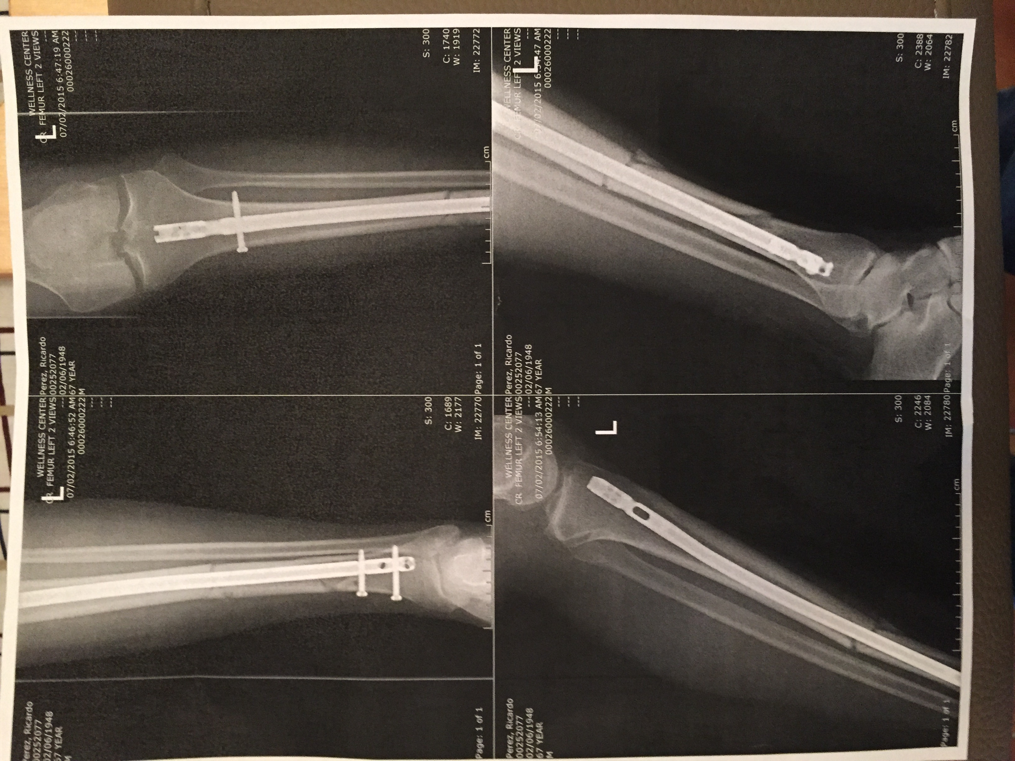 Here's my left leg, broken below the knee. The drove a nail down the bone and tuned it with those side screws. No more casts. Doctor said it weren't for my pelvic area I could walk on it immediately.