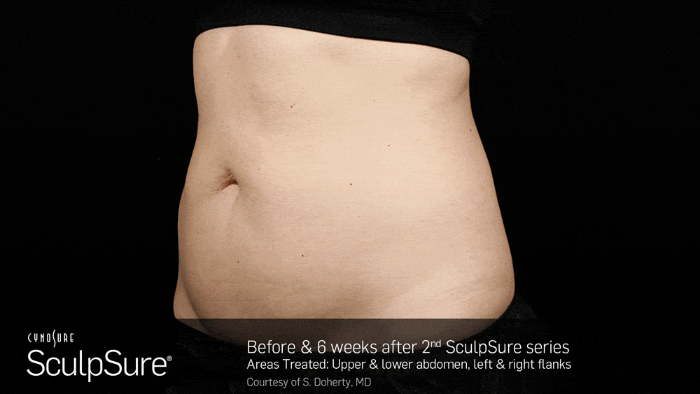 Medspa Toronto | SculpSure | Body Contouring | Civello — Civello