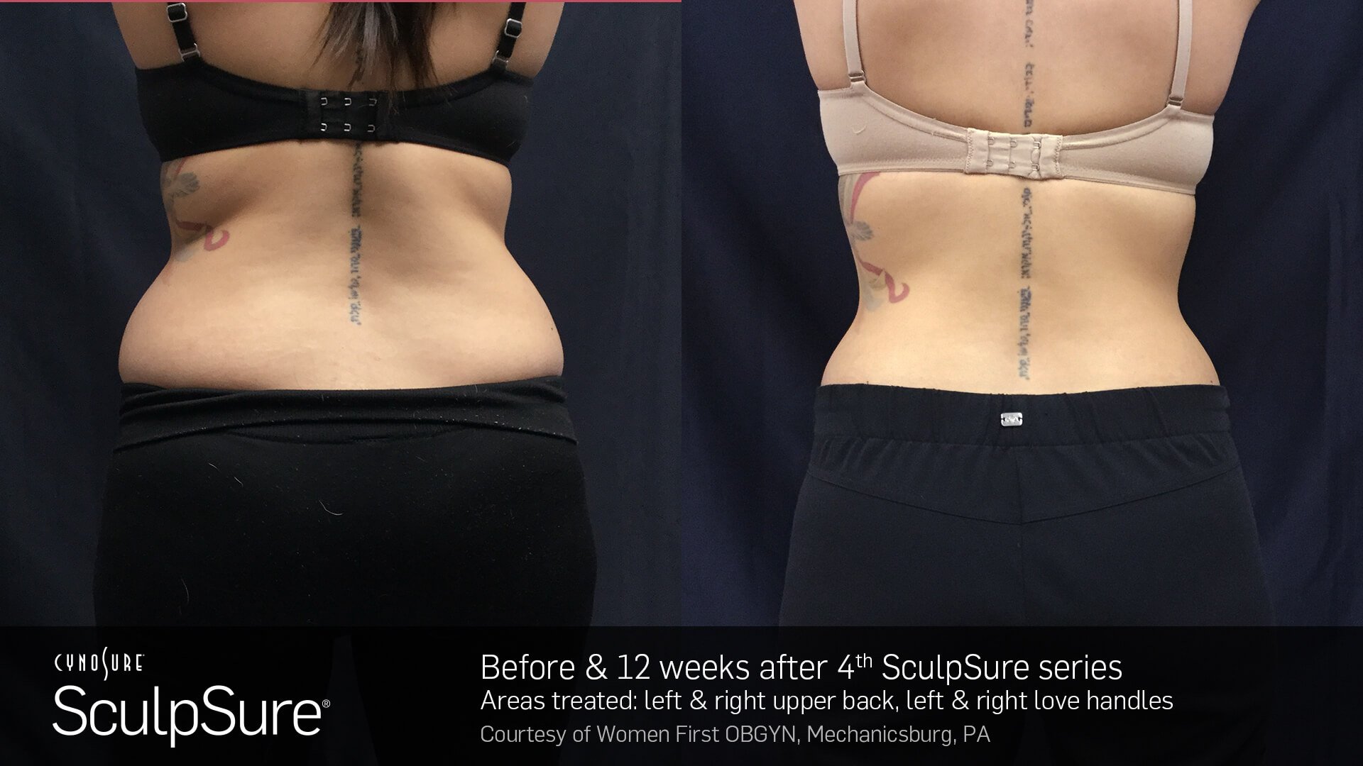 SculpSure BA2.jpg