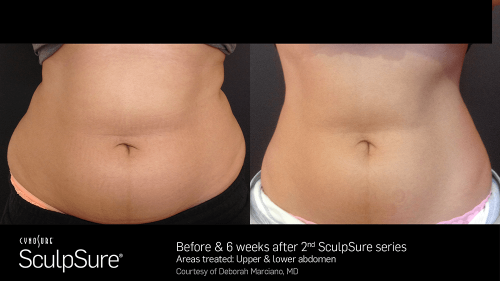 0717_BA_SculpSure_Marciano_2017_nobadge.png