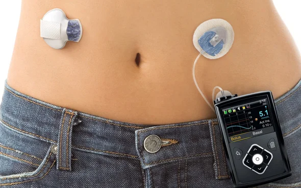Source: Medtronic I'd like to become a model for these types of pictures one day. I don't think my belly button is up to par, though. 