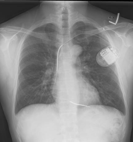 A normal chest X-ray after placement of an ICD, showing the ICD generator in the upper left chest and the ICD lead in the right ventricle of the heart. Note the 2 opaque coils along the ICD lead. Image Credit: Gregory Marcus, MD, MAS, FACC