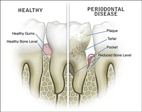 Gum disease diagram
